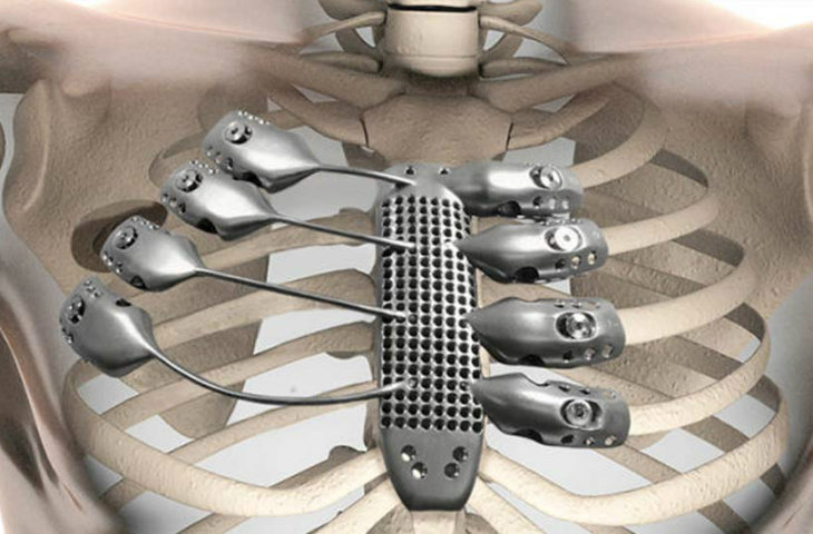 3D baskılı göğüs kafesi implante edildi!