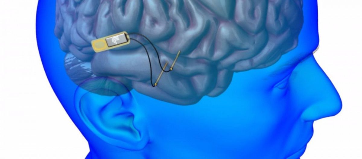 Beyin implantı, felç için bir çözüm sunabilir mi?
