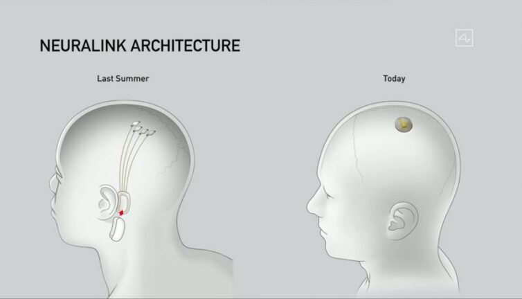 Elon Musk'ın Beyin Implant