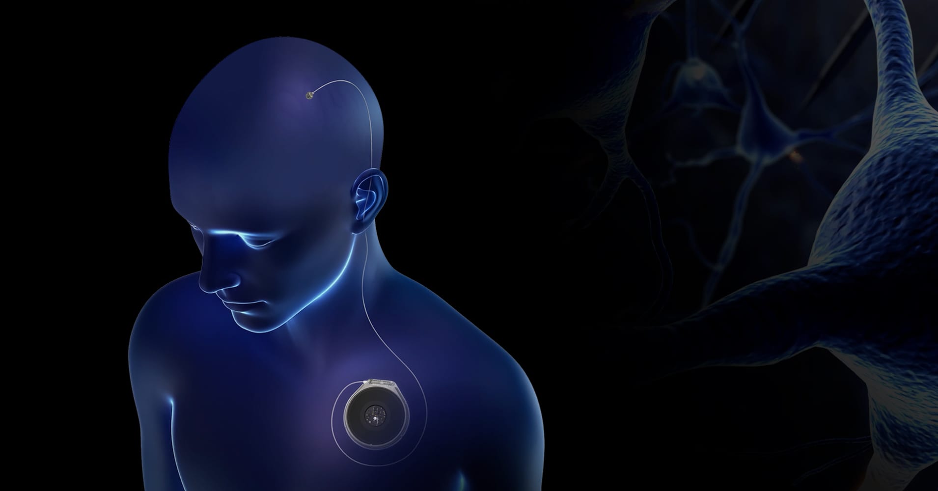 Paradromics, insan beynine gerçekleştirdiği ilk implant operasyonunu başarıyla tamamladı